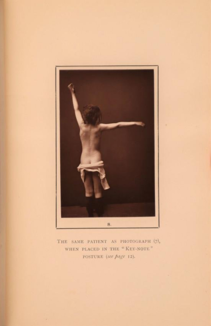 B. ROTH Lateral Curvature of the Spine 1st 1889