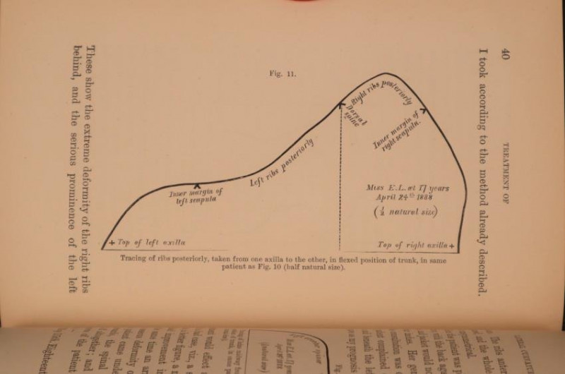 B. ROTH Lateral Curvature of the Spine 1st 1889