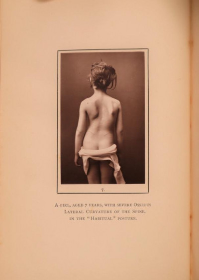 Image for Lot B. ROTH Lateral Curvature of the Spine 1st 1889